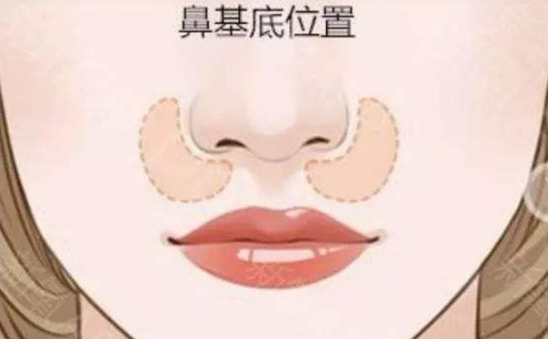 北京欧华PARKSUNMYUNG（朴宣洺）玻尿酸去鼻唇沟一般多少钱?案例反馈,价格表