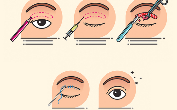 温州艺星双眼皮技术怎么样?报价多少|价格表